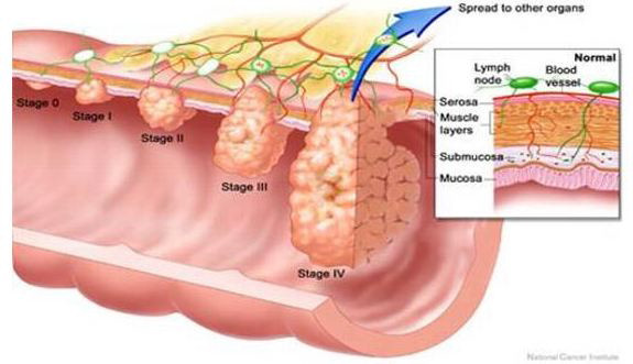 Sinus ache associated with tooth chronic sinusitis treatment forum