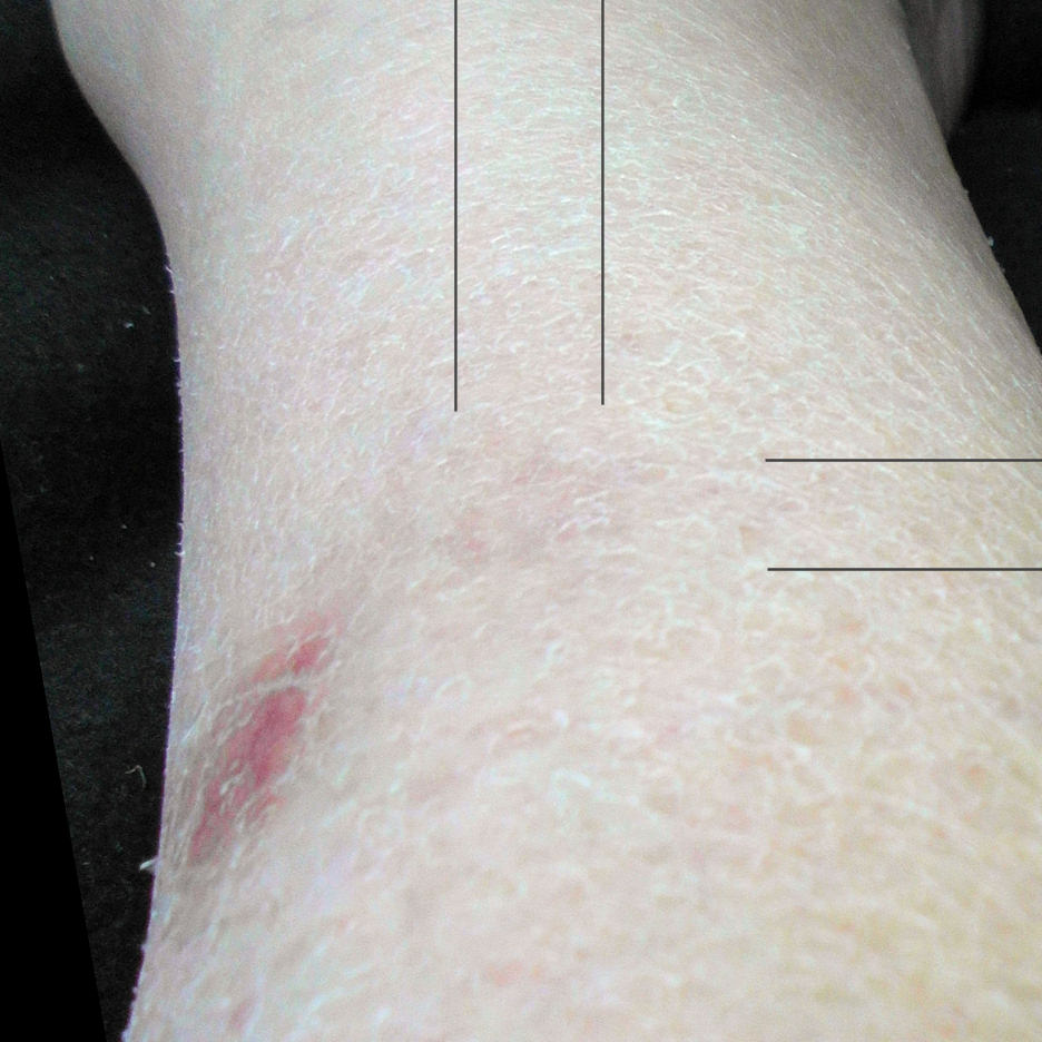 SAM_0710c Spider bite is still visible a year later, at center where the lines enclose.