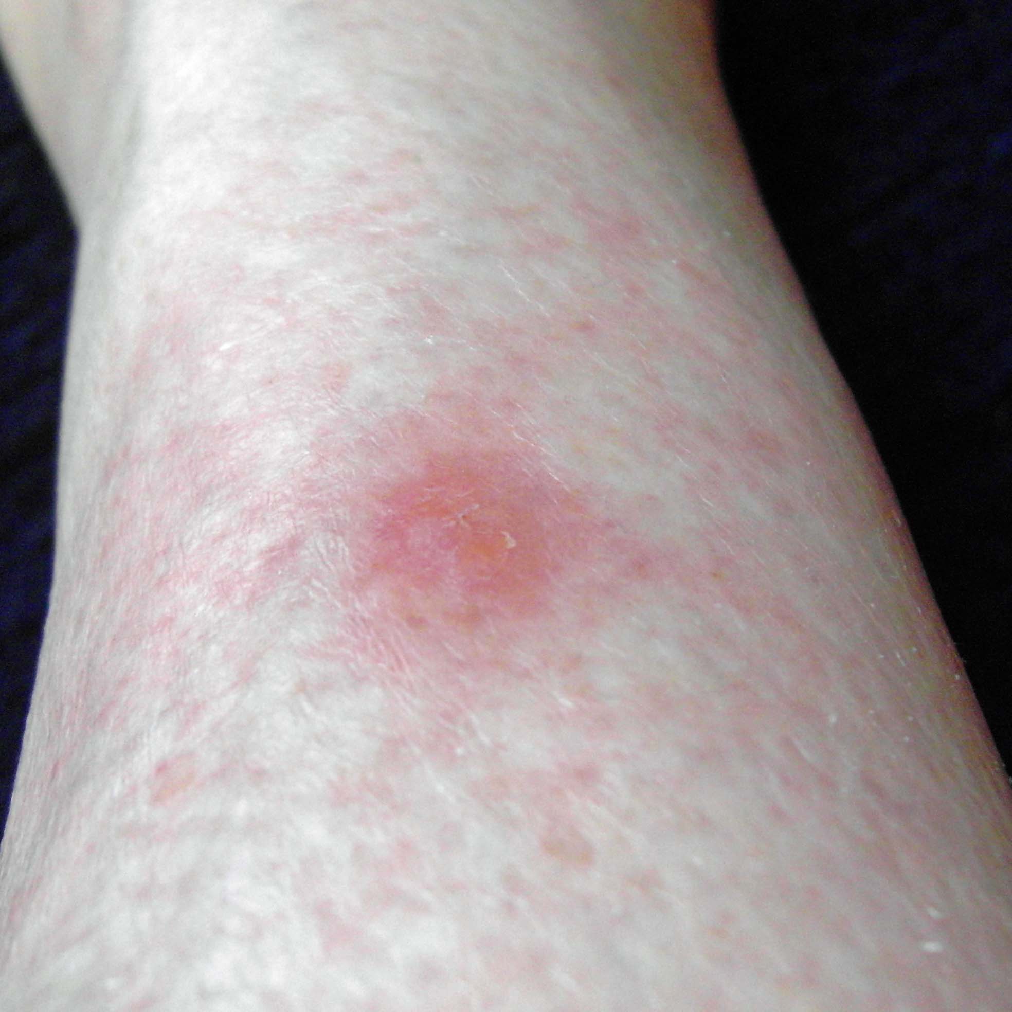 Brown Recluse Spider Bite First Hour Images And Photos Finder